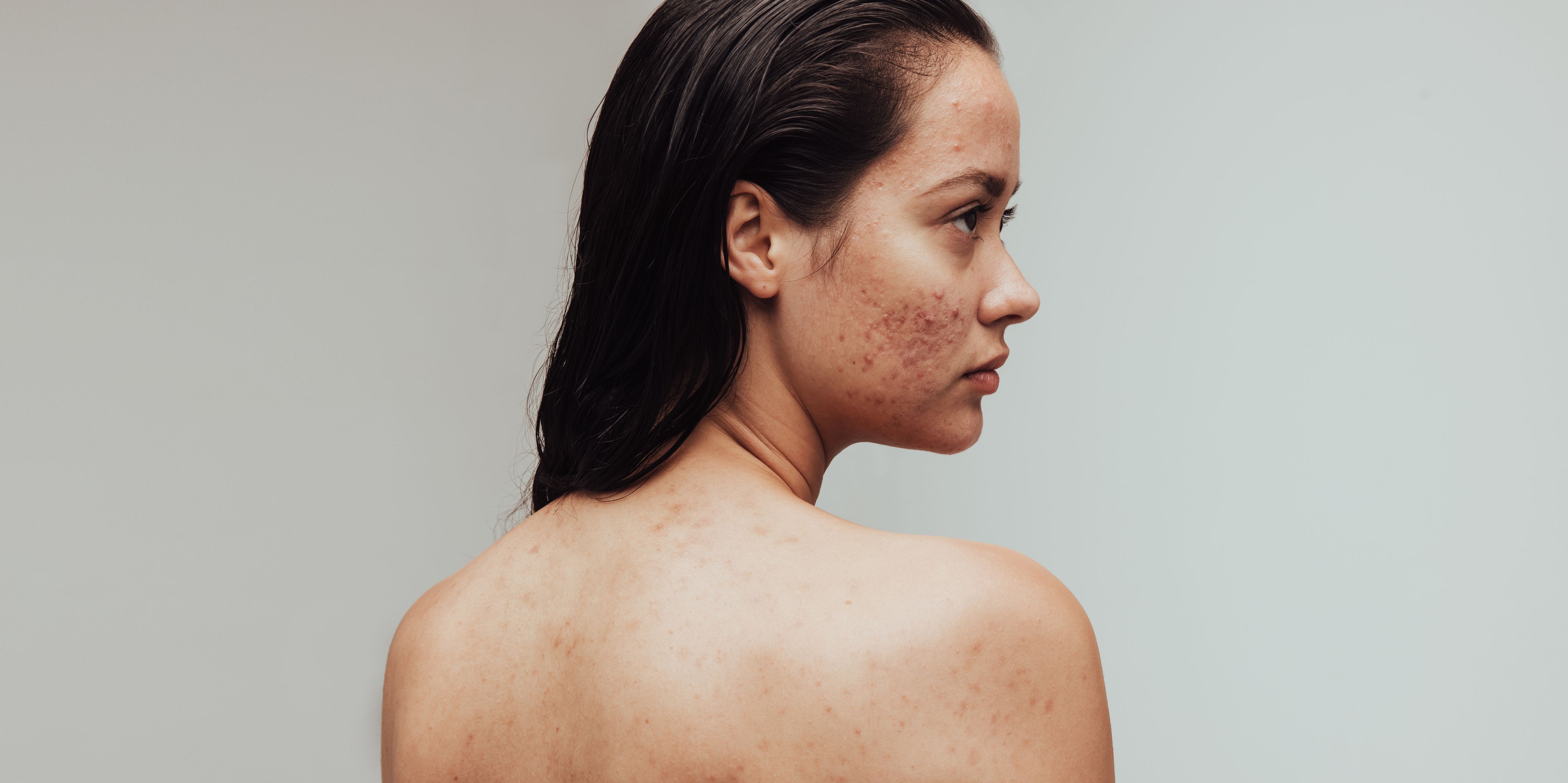 A young girl with acne on her face.